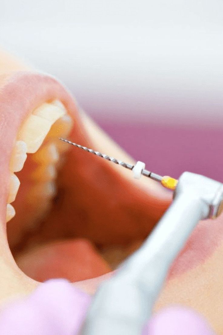 What Is Endodontics (Root Canal Treatment)?